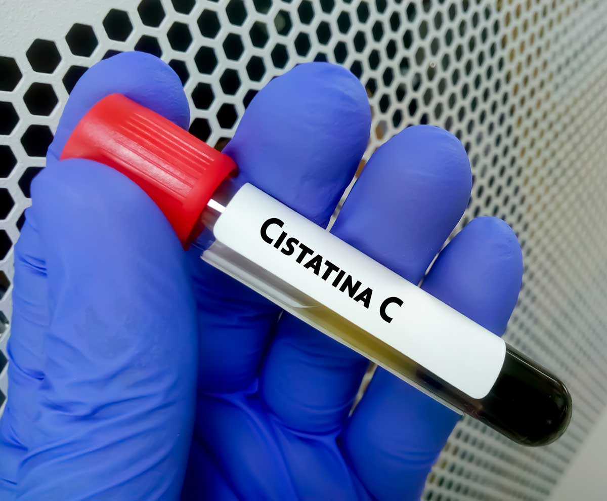 CISTATINA C EN SUERO